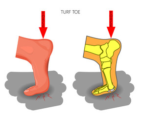 Vector illustration (diagram).Turf toe. Sport trauma. Mechanism of rupture of plantar plate of the first toe of the foot. External and skeletal views of an ankle.