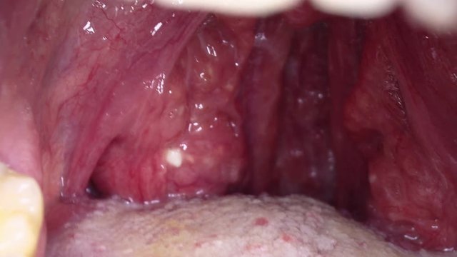 Close-up. Man's red throat. Purulent tonsillitis