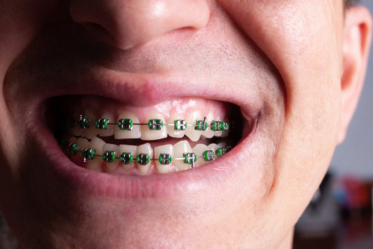 Mint 2024 green braces