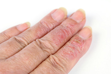 アレルギーの指