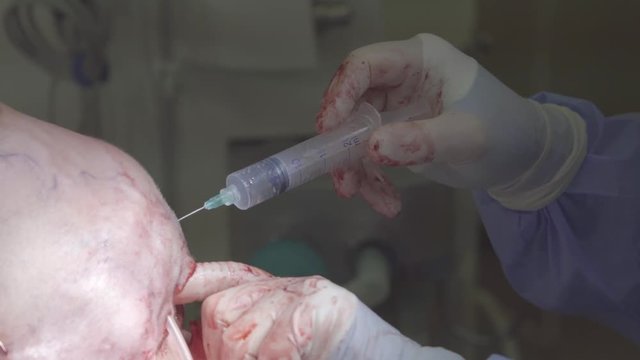 Surgeon makes an injection of saline into a sic tissues of the human head   close-up (4K, 25fps)