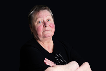 Portrait of unhappy elderly woman facing two skin diseases as rosacea and psoriasis vulgaris, no make-up