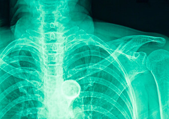 Film x-ray human's chest, rib, and spine in green color