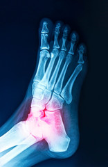 Film x-ray human's ankle with arthritis in red color