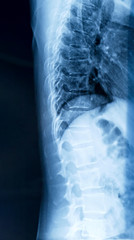 Film x-ray human's chest and spine in side view