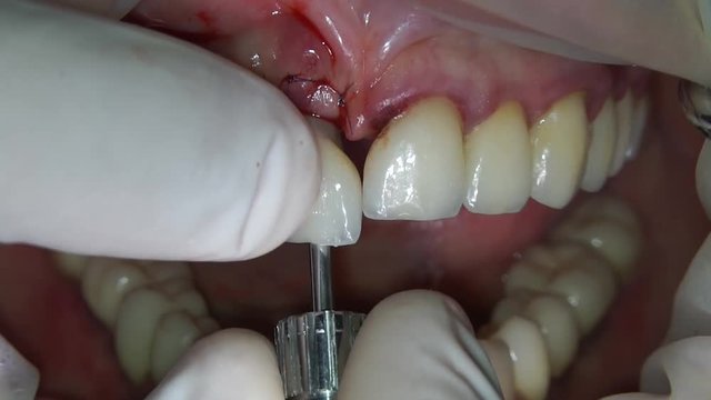 installation of dental crowns complete with the addition of soft tissues