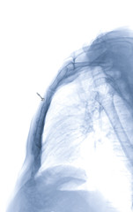 Sternum Lateral view show fracture of sternum in trauma case ( arrow head ).