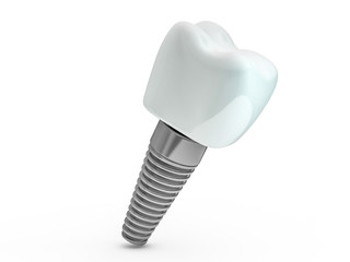 Dental implant dentist, tooth layout, plastics, man, teeth, treatment. 3D