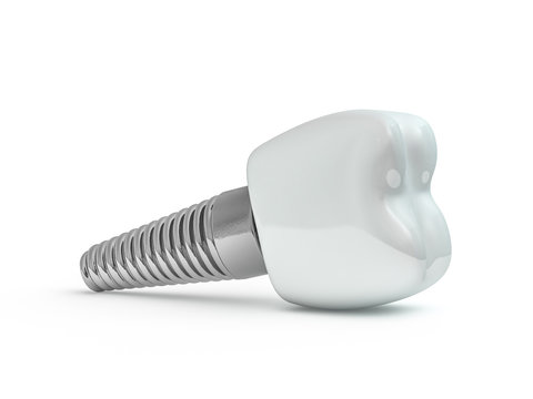 Dental implant dentist, tooth layout, plastics, man, teeth, treatment. 3D