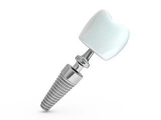 Dental implant dentist, tooth layout, plastics, man, teeth, treatment. 3D