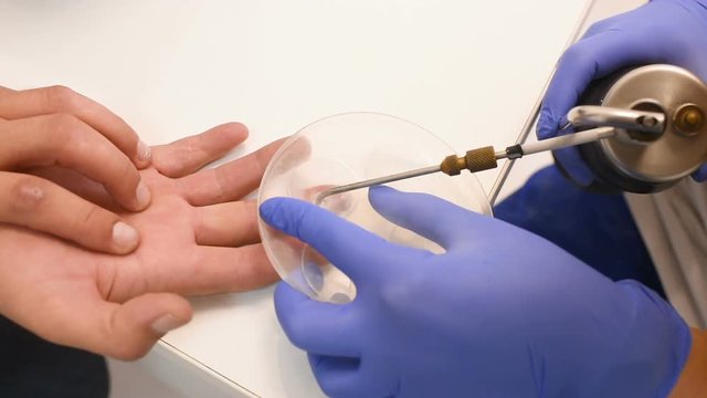 Removal of papillomas and warts on the hand with liquid nitrogen in a special device with a probe - cryodestructors. Cryotherapy or cryosurgery - cold treatment.