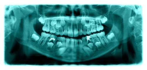 Panoramic radiograph is a scanning dental X-ray of the upper jaw maxilla and lower jawbone mandible a child aged 7 seven years. - 244221222