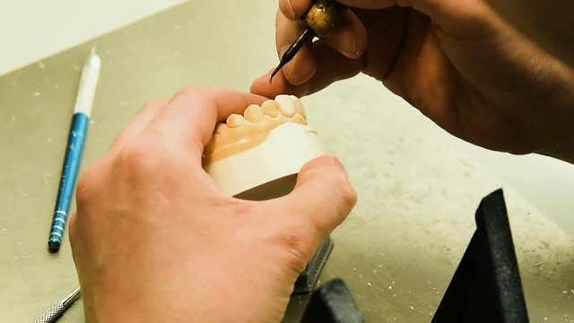 Dentist makes a dental implant prosthesis made of plaster cast. Orthopedic dentistry, prosthetics.