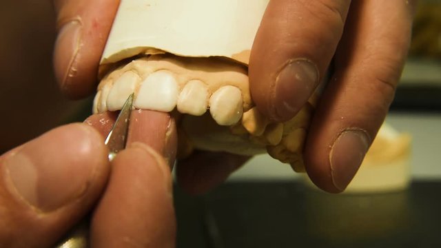 Dentist makes a dental implant prosthesis made of plaster cast. Orthopedic dentistry, prosthetics.