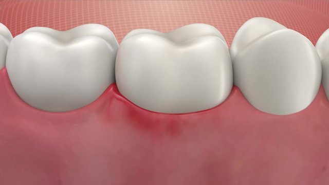 Damaged Gum and Teeth