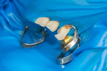two chewing side teeth of the upper jaw after treatment of caries. Restoration of the chewing...