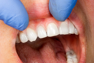 two chewing side teeth of the upper jaw after treatment of caries. Restoration of the chewing surface with a photopolymer filling material using the Rubber Dam system © Сергей Кучугурный