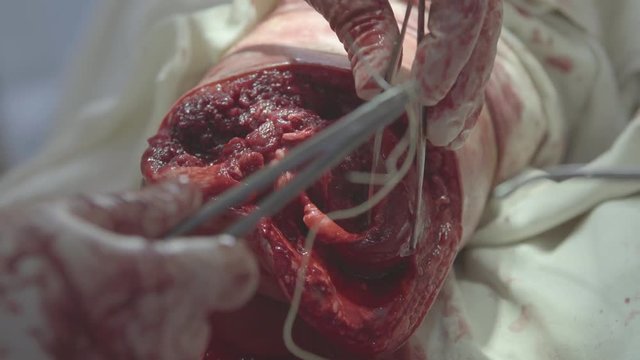 Surgeons begin form and sew the stump after the shin amputation with   surgical needle and threads in bloodstained gloves (close-up, 4K, 25fps)