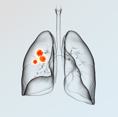 Lung cancer, medically 3D illustration on light background