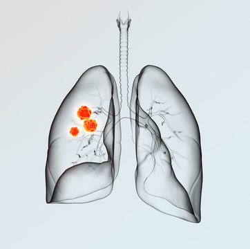 Lung Cancer, Medically 3D Illustration On Light Background