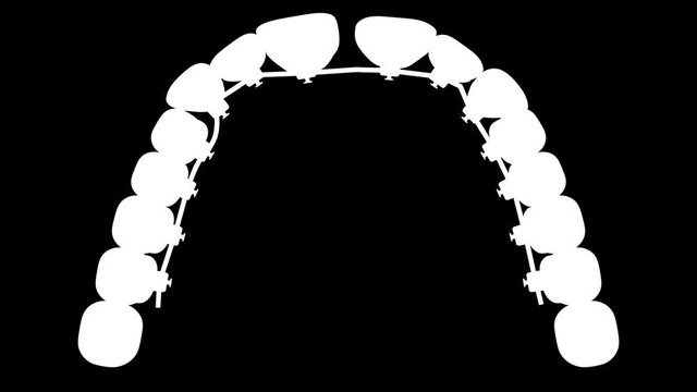 Lingual Braces. 3D model rackets