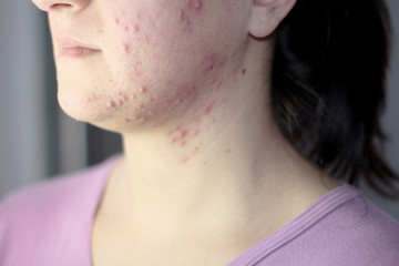 Allergy concept,young girl with problematic pimple on the face.-image. - 244407438