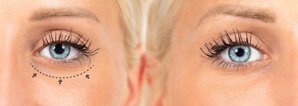 Lines for blepharoplasty operation before and after surgical plasty