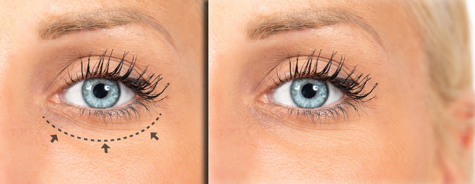 Surgical plasty lines of a blepharoplasty, eyes before and after lifting operation