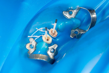 dental restoration of rotten roots of the teeth with ceramic crowns. cast posts dentistry