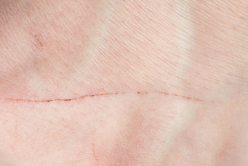 Scratch on human skin