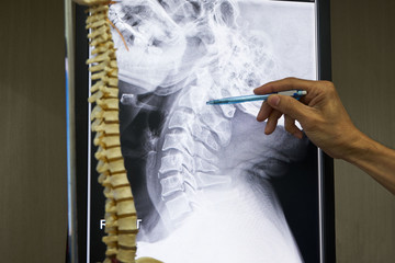 A neurosurgeon pointing at cervical spine x-ray