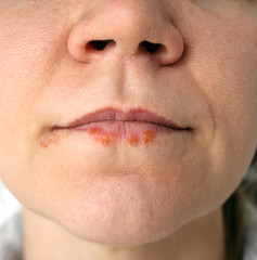 Cold sores