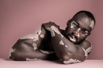 Close up fashion portrait of a male afro or african model with white pigmentation. Concept of no...