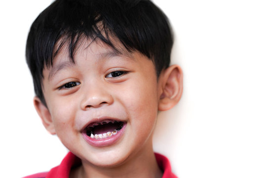 Asian Kid patient open mouth showing cavities teeth decay.  unhealthy teeth concept.              