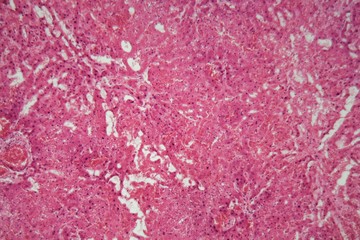 Liver tissue with Amyloidosis under a microscope.