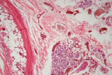 Human lung tissue with Pulmonary embolism under a microscope.