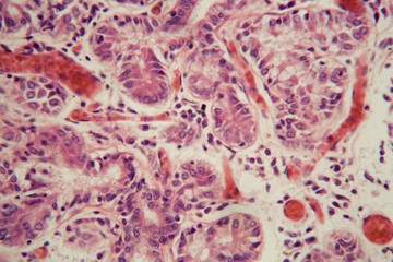Human lung tissue with Pulmonary embolism under a microscope.