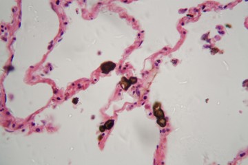 Human lung tissue with dust and coal particles under the microscope.
