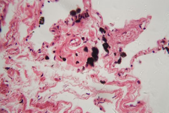 Human lung tissue with dust and coal particles under the microscope.