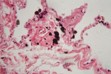 Human lung tissue with dust and coal particles under the microscope.