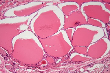 Cells of a human thyroid gland with swelling under a microscope.