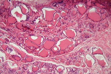 Cells of a human thyroid gland with swelling under a microscope.
