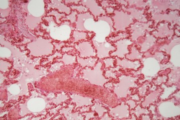 Lung tissue with pneumonia infection caused by flu (Viral pneumonia) under a microscope.