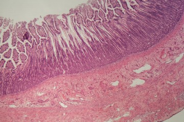Microscope photo of a large intestine section with inflammation (Colitis).