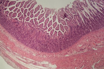 Microscope photo of a large intestine section with inflammation (Colitis).