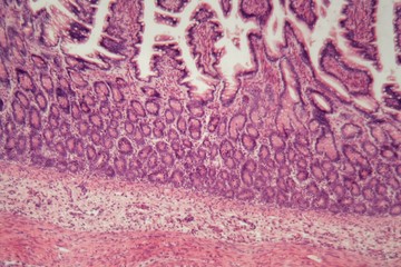 Microscope photo of a large intestine section with inflammation (Colitis).