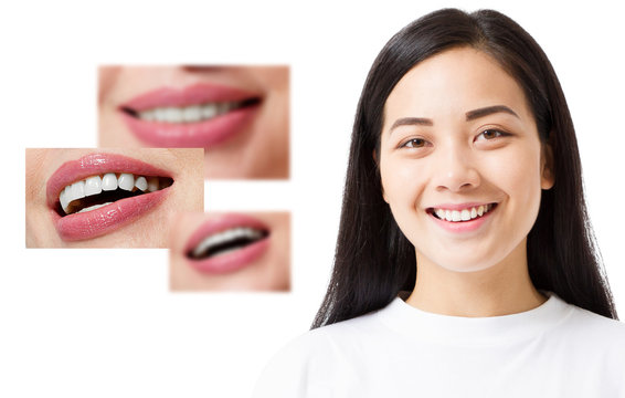 Collage of healthy smiling people. Beautiful asian young woman with white veneers and perfect smile. Tooth care dental medicine. Isolated and copy space.