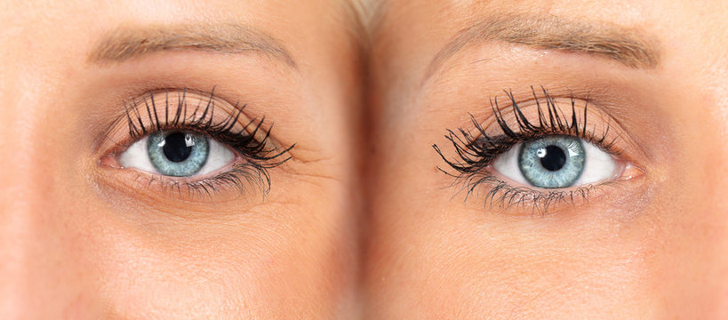 Female eyes before and after wrinkles removal
