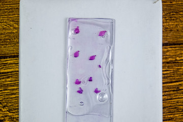 Slices of the tumor under glass. Histological examination of tumor cells for the presence of cancer. Samples of tumor cells under the sleek against the background of the lamp.