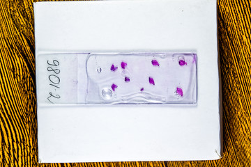 Slices of the tumor under glass. Histological examination of tumor cells for the presence of...